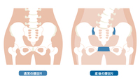 動くと骨盤周りが痛いわけとは？